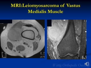 MRI:Leiomyosarcoma of Vastus
Medialis Muscle
 