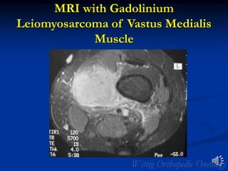 MRI with Gadolinium
Leiomyosarcoma of Vastus Medialis
Muscle
 