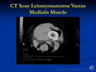 CT Scan Leiomyosarcoma Vastus
Medialis Muscle
 