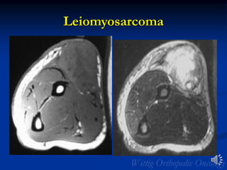 Leiomyosarcoma
 