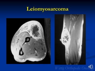 Leiomyosarcoma
 