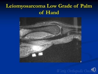 Leiomyosarcoma Low Grade of Palm
of Hand
 