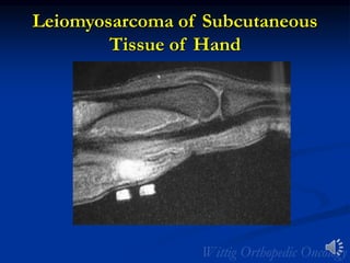 Leiomyosarcoma of Subcutaneous
Tissue of Hand
 