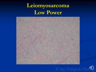 Leiomyosarcoma
Low Power
 