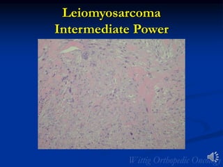 Leiomyosarcoma
Intermediate Power
 
