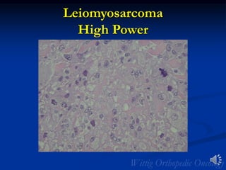 Leiomyosarcoma
High Power
 