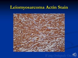 Leiomyosarcoma Actin Stain
 