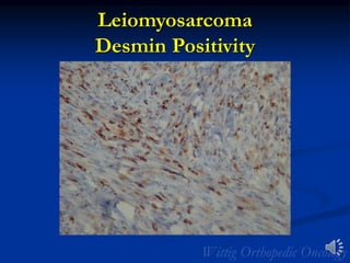 Leiomyosarcoma
Desmin Positivity
 