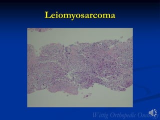 Leiomyosarcoma
 