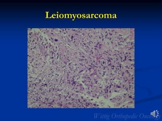Leiomyosarcoma
 