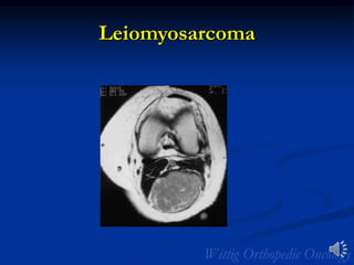 Leiomyosarcoma
 