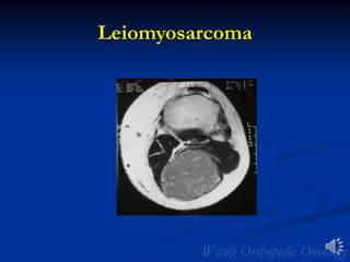 Leiomyosarcoma
 