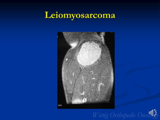 Leiomyosarcoma
 