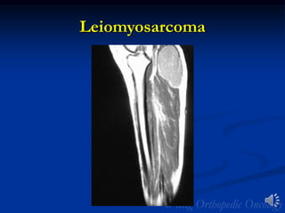 Leiomyosarcoma
 