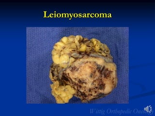 Leiomyosarcoma
 