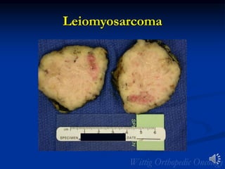 Leiomyosarcoma
 