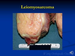 Leiomyosarcoma
 