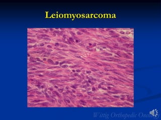 Leiomyosarcoma
 