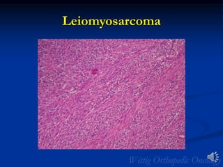 Leiomyosarcoma
 