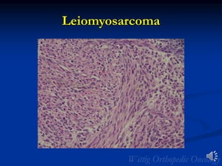 Leiomyosarcoma
 