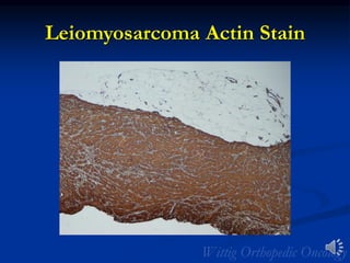 Leiomyosarcoma Actin Stain
 