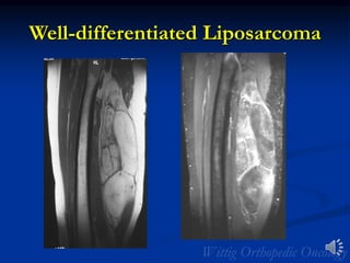 Well-differentiated Liposarcoma
 