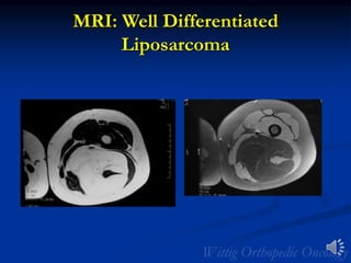 MRI: Well Differentiated
Liposarcoma
 