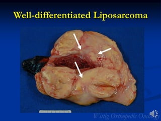 Well-differentiated Liposarcoma
 