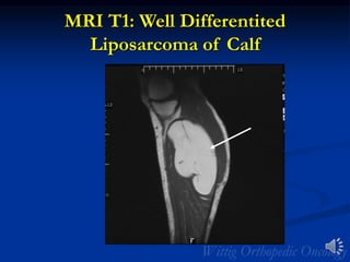 MRI T1: Well Differentited
Liposarcoma of Calf
 