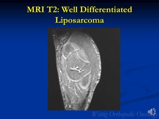 MRI T2: Well Differentiated
Liposarcoma
 