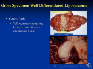 Gross Specimen Well Differentiated Liposarcoma
• Gross Path:
• Yellow, mature appearing
fat mixed with fibrous
and myxoid tissue
 