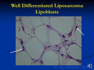Well Differentiated Liposarcoma
Lipoblasts
 