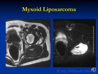 Myxoid Liposarcoma
 