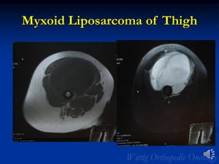 Myxoid Liposarcoma of Thigh
 