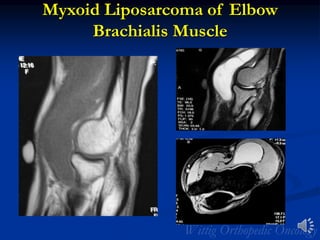Myxoid Liposarcoma of Elbow
Brachialis Muscle
 