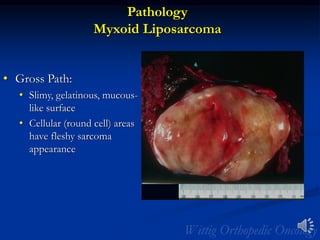 Pathology
Myxoid Liposarcoma
• Gross Path:
• Slimy, gelatinous, mucous-
like surface
• Cellular (round cell) areas
have fleshy sarcoma
appearance
 
