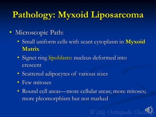 Pathology: Myxoid Liposarcoma
• Microscopic Path:
• Small uniform cells with scant cytoplasm in Myxoid
Matrix
• Signet ring lipoblasts: nucleus deformed into
crescent
• Scattered adipocytes of various sizes
• Few mitoses
• Round cell areas—more cellular areas; more mitoses;
more pleomorphism but not marked
 
