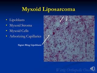 Myxoid Liposarcoma
• Lipoblasts
• Myxoid Stroma
• Myxoid Cells
• Arborizing Capillaries
Signet Ring Lipoblasts
 