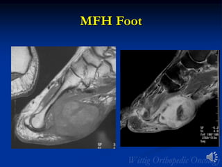 MFH Foot
 