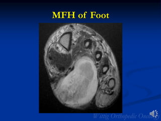 MFH of Foot
 