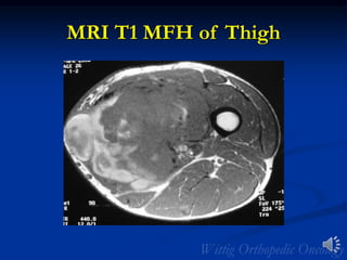 MRI T1 MFH of Thigh
 
