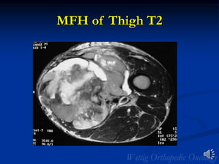 MFH of Thigh T2
 