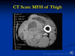 CT Scan: MFH of Thigh
 