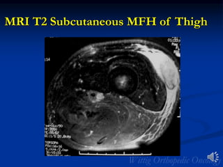 MRI T2 Subcutaneous MFH of Thigh
 