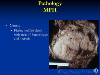 Pathology
MFH
• Gross:
• Fleshy, multilobulated
with areas of hemorrhage
and necrosis
 