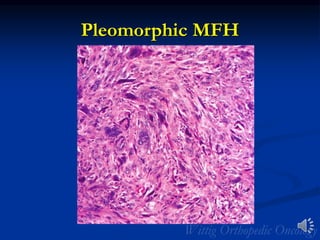 Pleomorphic MFH
 