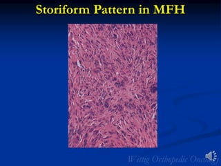 Storiform Pattern in MFH
 