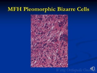MFH Pleomorphic Bizarre Cells
 