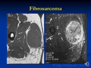 Fibrosarcoma
 