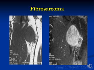 Fibrosarcoma
 
